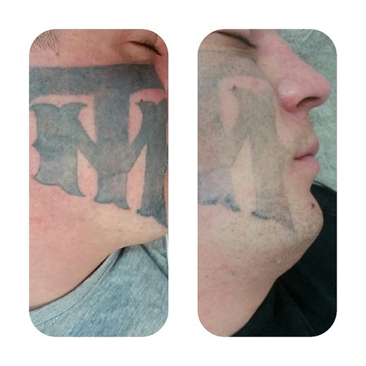 Ipl Laser Tattoo Removal : 3 In 1 IPL Hair Removal Nd Yag Laser Tattoo Removal Laser ... : Treatment plans and tattoo types.